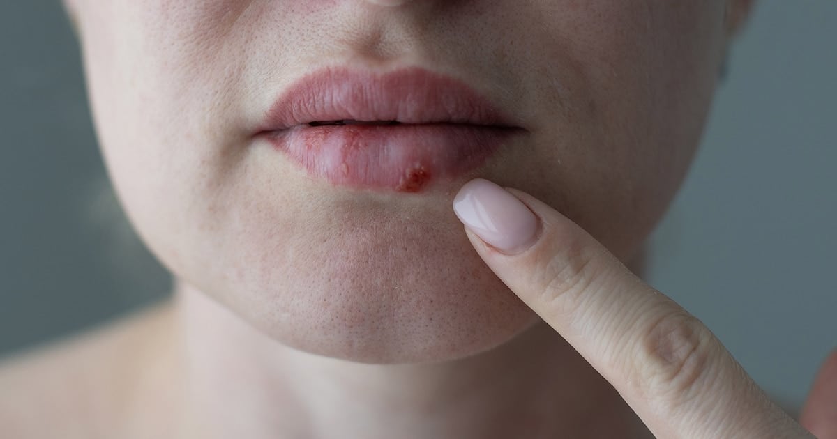 Una pastilla que cambia el pronóstico del herpes cuando el cuerpo ya no puede defenderse
